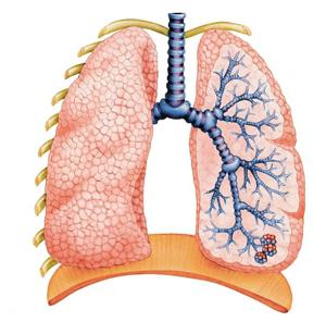 Обструктивна хвороба легень